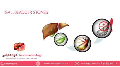 Gallbladder Stone Gallstones Causes Symptoms And Treatment By Ananya