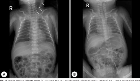 Figure 2 From Pyriform Sinus Fistula Presenting As An Air Filled Neck