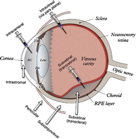 Gene Therapy For Blinding Pediatric Eye Disorders Advances In Pediatrics