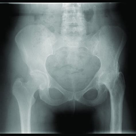 Preoperative X Ray Figure 2 Postoperative X Ray Download Scientific Diagram