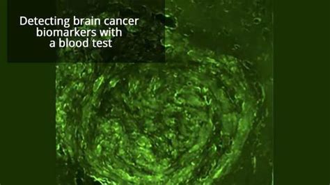 Noninvasive Brain Tumor Biopsy On The Horizon Technology Networks