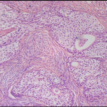 Microphotograph Showing Nests Of Transitional Epithelial Urothelial