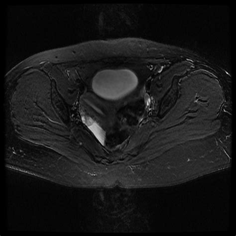 Unicornuate Uterus Radiology Reference Article Radiopaedia Org