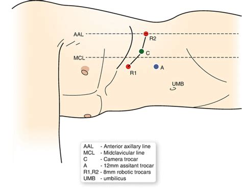 Robot Assisted Total And Partial Adrenalectomy Abdominal Key