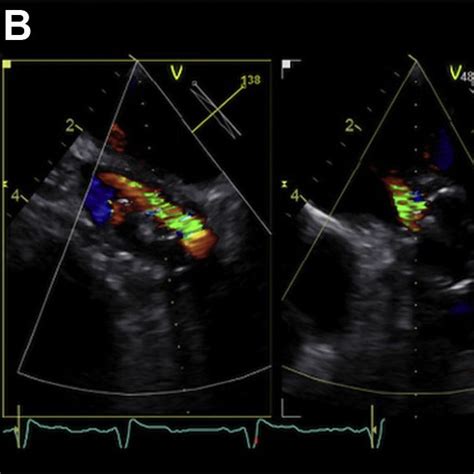 Transesophageal Echocardiographic Images During Follow Up Download Scientific Diagram