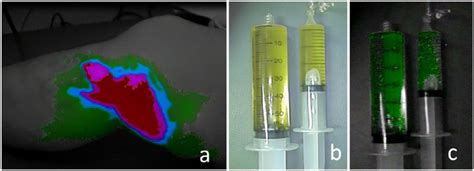 The Findings Of Indocyanine Green Icg Lymphography With Color Mapping