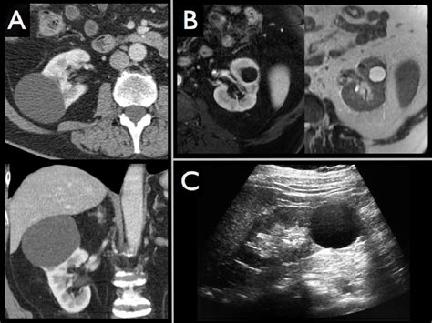 Figure 2 From The Bosniak Classification System Of Renal Cysts Revisited Celebrating 20 Years