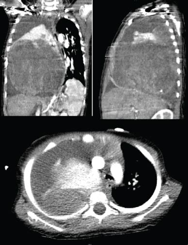 Pleuropulmonary Blastoma Is A Rare And Deadly Tumor In Pediatric Population