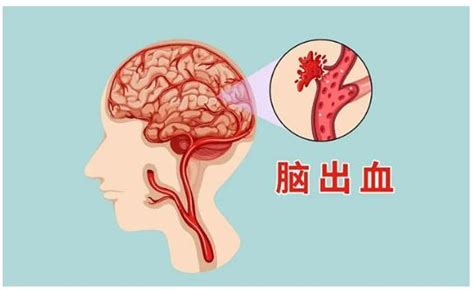 脑出血怎么处理 京东健康