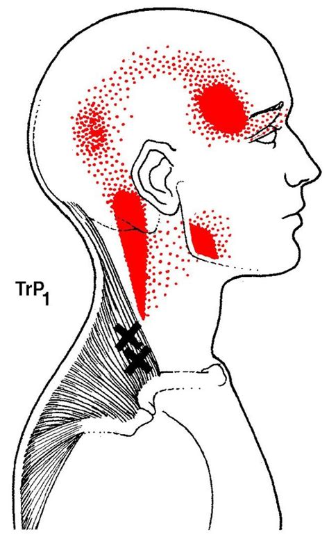 Dry Needling Therapy Trigger Point Muscle Treatment California Acupuncture And Dry Needling