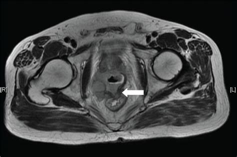 Prostate Cancer Mri Images