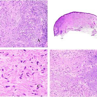 Desmoplastic melanoma. A Junctional component of melanoma in situ... | Download Scientific Diagram