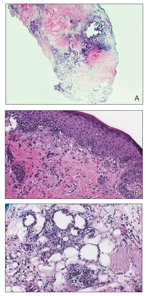 Juvenile Dermatomyositisassociated Panniculitis Mdedge Dermatology