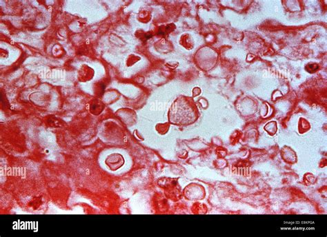 This Photomicrograph Depicted Numbers Of Cryptococcus Neoformans Fungi Etiologic Agents