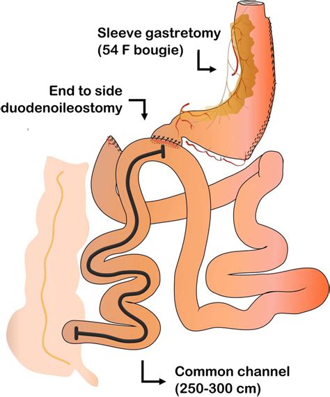 Single Anastomosis Duodeno Ileal Anastomosis With Sleeve Gastrectomy