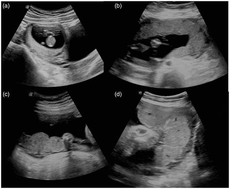 Circummarginate Placenta Ultrasound