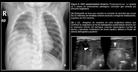 Multicystic Peritoneal Mesothelioma Histology