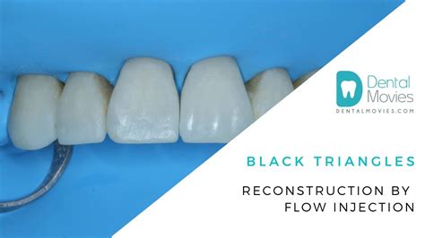 Black Triangles Reconstruction By Flow Injection 🦷 Youtube