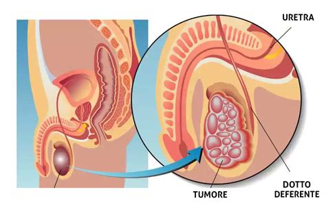 Tumore Testicolo Andrologia Bologna Equipe S Orsola