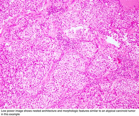 Pathology Outlines Neuroendocrine Carcinoma