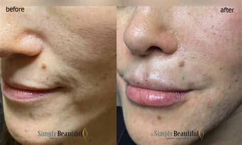 Liquid Face Lift Restore Volume Injection Dr Peter Kim Surgery