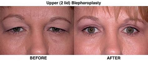 Blepharoplasty Hooded Eye Surgery Eyelid Surgery Eye Surgery