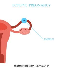 Ectopic Pregnancy Images Stock Photos Vectors Shutterstock