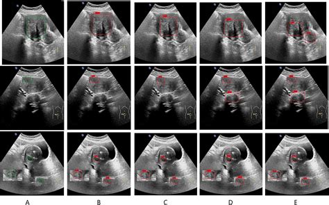 Real Time Automatic Assisted Detection Of Uterine Fibroid In Ultrasound