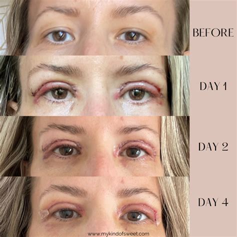 Upper Eyelid Lift Before After My Kind Of Sweet