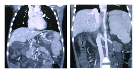 The effects of splenic vein thrombosis on normal venous anatomy. Note ...