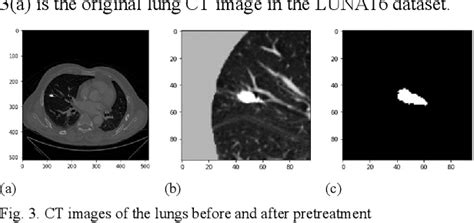 Figure 1 From Lung Nodule Segmentation Method Based On 3D Rem Unet