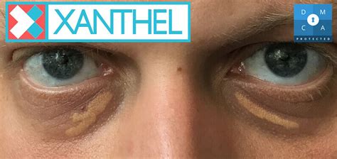 Xanthelasma And Xanthomas Pictures And Images Xanthel