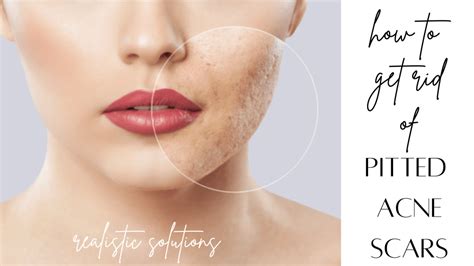 how to get rid of pitted acne scars at home