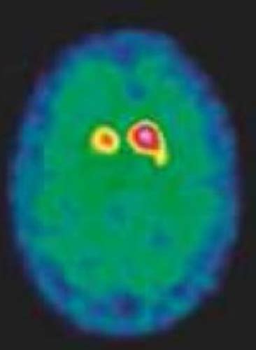 Items Et Confusion Troubles Neurocognitifs Majeurs Du Sujet