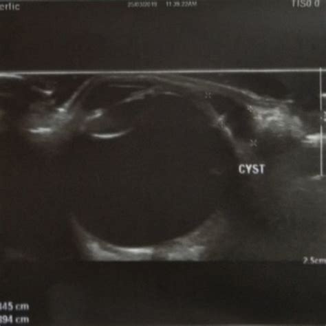 (PDF) A case of simple bilateral dacryops: A review of literature