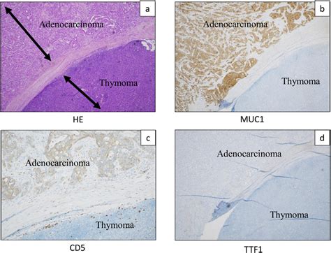 The Pathological Finding Of This Tumor The Tumor Cells Were Mainly