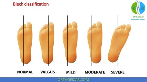 Metatarsus Adductus Easy Explained OrthoFixar 2025