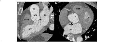 Reformatted 3 Chamber View A And Axial B Cta Of The Heart And