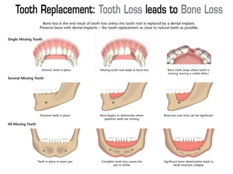 Bone Loss After Tooth Extraction Naperville Oral And Maxillofacial