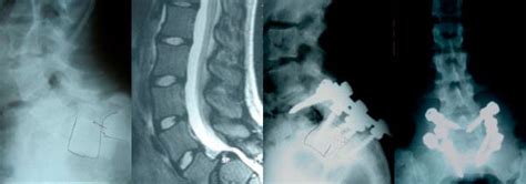 Isthmic Spondylolisthesis - Scoliosis and Spine Associates