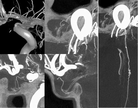 Superior Hypophyseal Artery