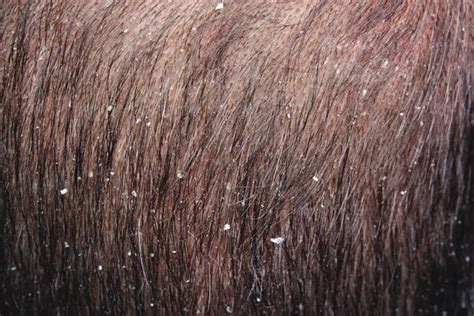 10 Tips To Prevent And Treat Dandruff This Winter Top 10 Home Remedies