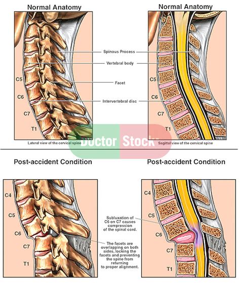 Spine subluxation - mzaerbest