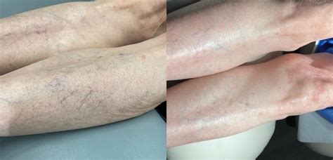 Sclerotherapy And Laser Vein Treatment Before And After Photos Patient 51