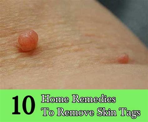 10 Home Remedies To Remove Skin Tags - Home and Gardening Ideas