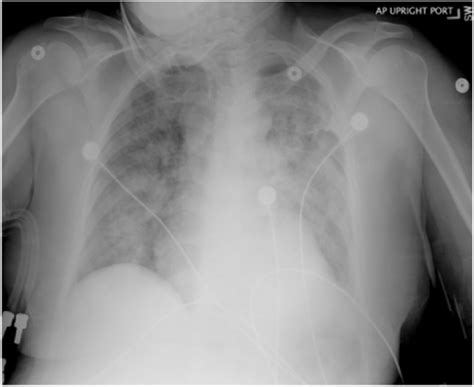 Chest Radiograph On Admission Download Scientific Diagram