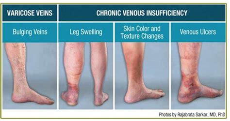 Is Your Leg Pain Venous Insufficiency CVR Blog USA