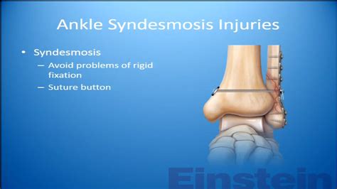 Any Consensus On The Syndesmosis An Update YouTube