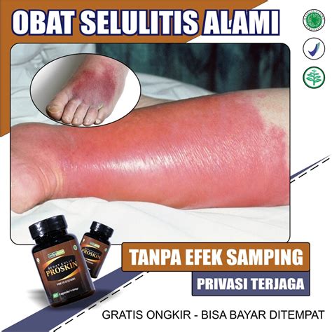 Jual Obat Selulitis Penghilang Bekas Luka Bakar Diabetes Koreng Infeksi