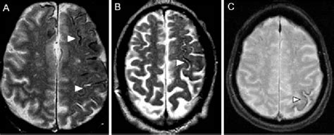 Figure From Superficial Siderosis A Potential Diagnostic Marker Of